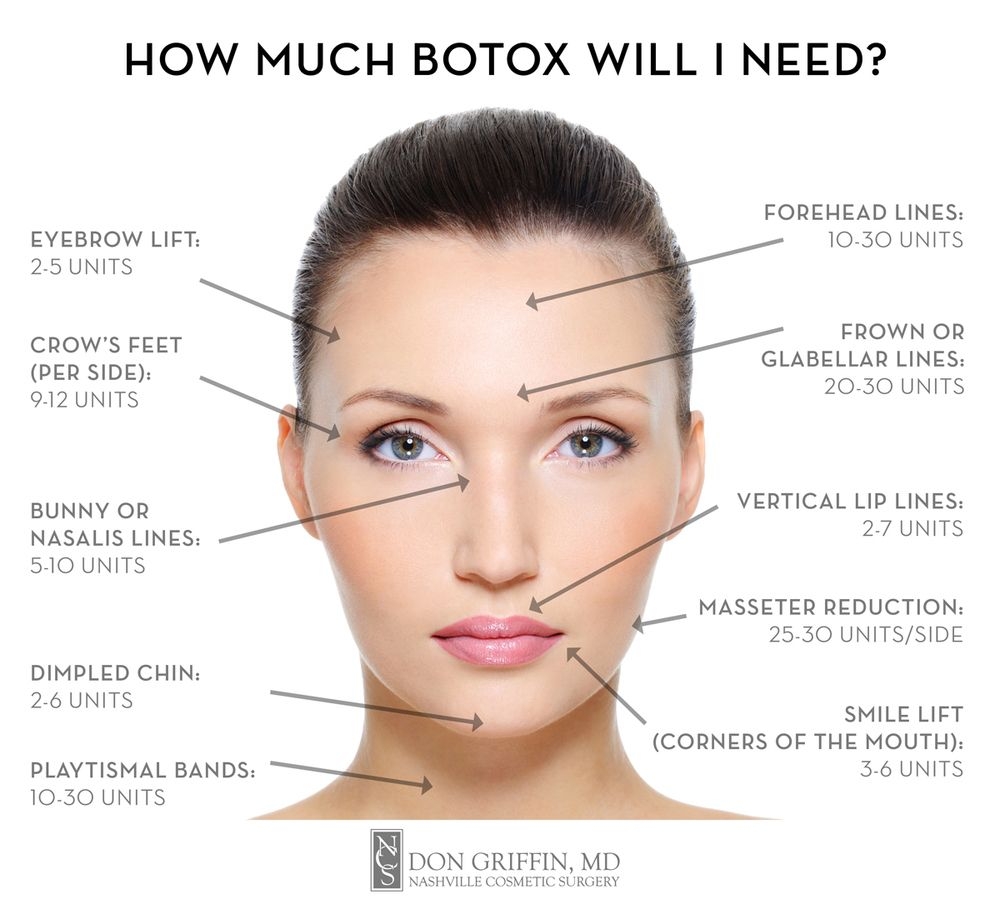 Printable Botox Injection Face Map