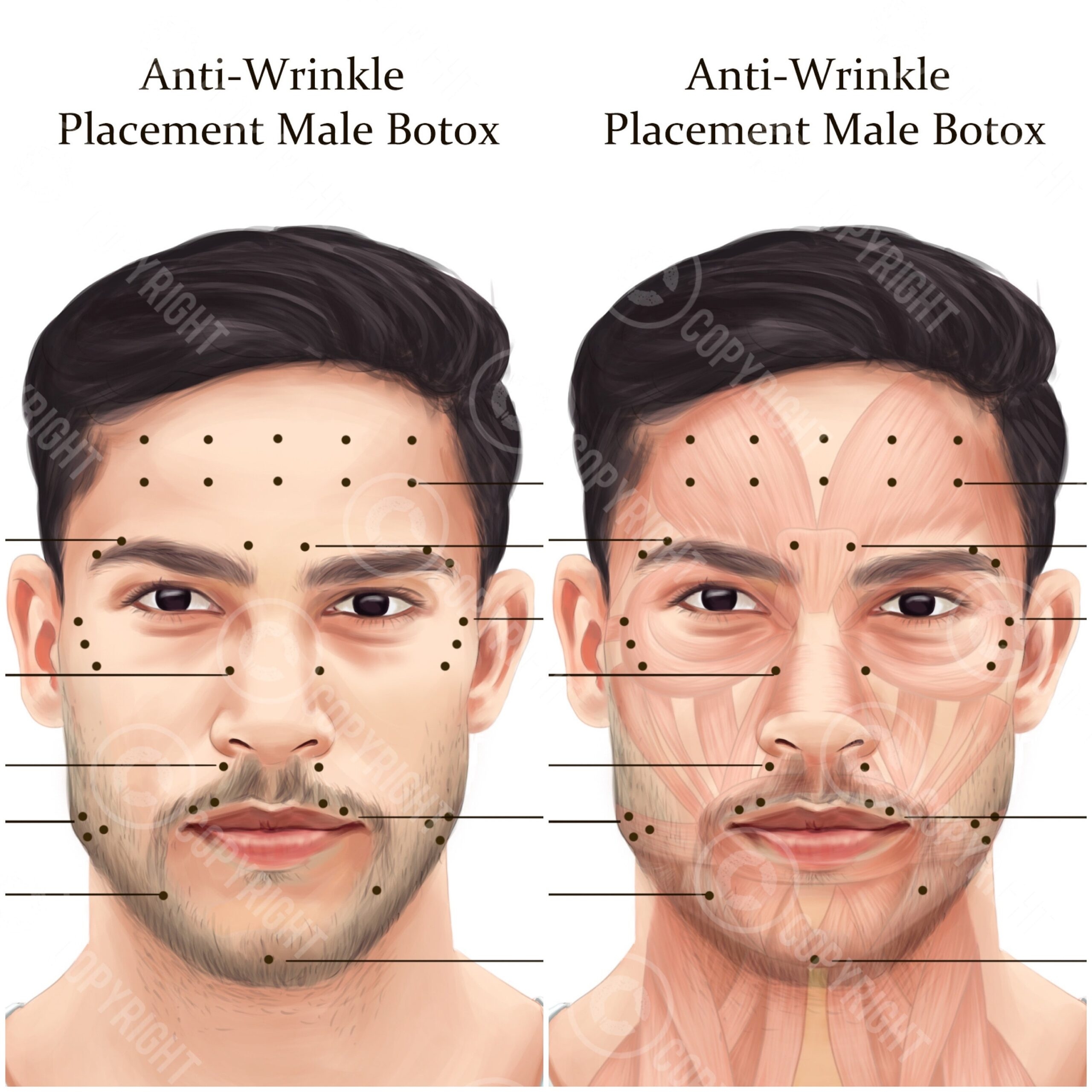 Printable Botox Injection Face Map Free Printable Maps